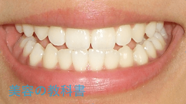 私の歯の画像
